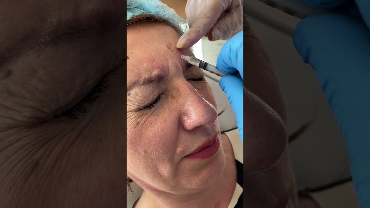 👨‍🔬 Демонстрація курсу Ботулінотерапія FULL FACE. Відпрацювання на моделі (рос) 👨‍🔬