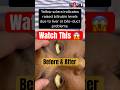 Jaundice Before And After Treatment Yellow Eyes Turn White Causes Recovery Dr Sachin Deore 