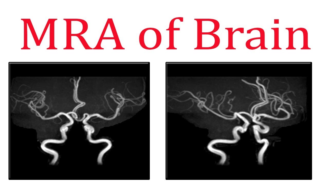 Cerebral Mra blood-pressure-chart-by-age-51-off