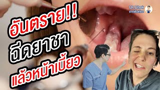 อันตราย!! ทำฟันแล้วหน้าเบี้ยวจริงไหม ?!! | คลายปัญหารากฟันเทียมกับหมอโชค