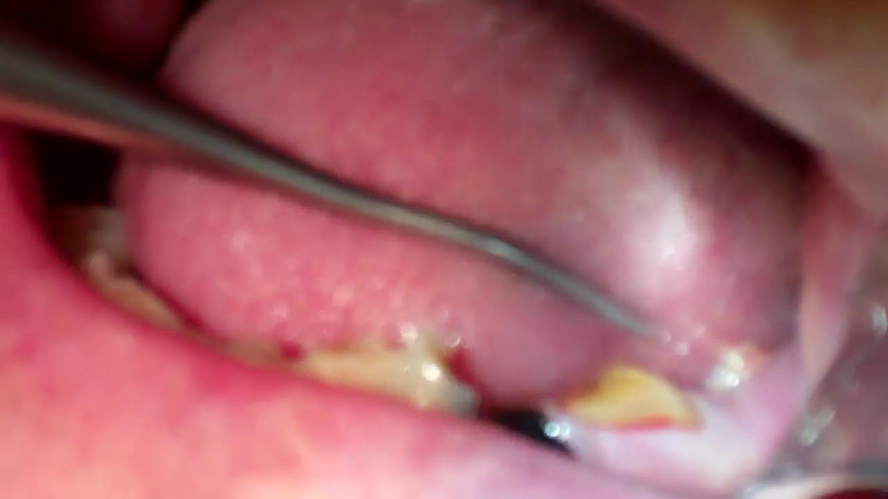 Infected Tooth Spreads Bacteria And Pus YouTube infected-tooth-spreads-bacteria-and-pus-youtube