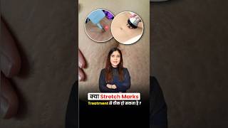 Kya Stretch Marks Puri Tarah Remove Ho Sakte Hain  Dermatologist