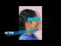 1 clips and braces in chennai 2018  senthil dental care