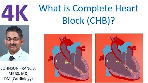 What is Complete Heart Block?