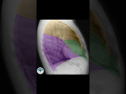 Chest x-ray frontal