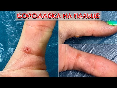 Бородавка на пальце как убрать? / Прижигание бородавки