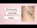 Get Rid of Warts Safely – Homeopathic Case Study by Dr Rupam Sharma - MD (Hom)