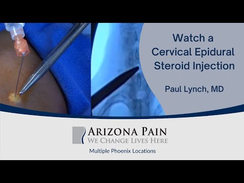 Epidural steroid injection back recovery