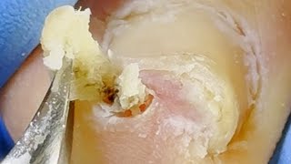 ✨Curly Ingrown Toenails Cause A Lot Of Damage To Toes【Xue Yidao】