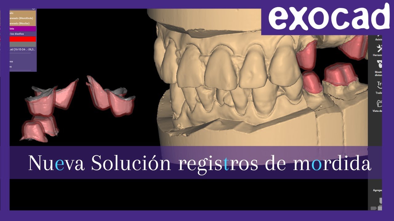 Новое решение Exocad для регистрации прикуса