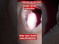 #dentaltreatment #dentalprocedure ##oralhealth Live dental extraction