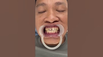 Lột xác nụ cười cùng nha khoa Việt Úc ❤️☎️☎️☎️