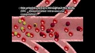 Disseminated Intravascular Coagulation (DIC) and Placental Abruption by Cal Shipley, M.D.