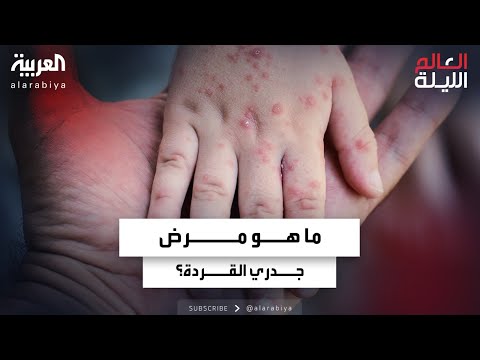 ما هو مرض جدري القردة وما درجة خطورته وطريقة العدوى به