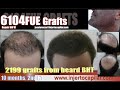 6104fue grafts repair nw vi with bht 2199 g doll hair 2step strategyinjertocapilarcom522014