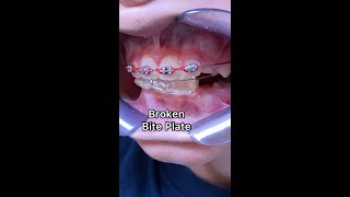 Braces Emergency - Broken Bite Plate - Broken Orthodontic appliance - Tooth Time Family Dentistry