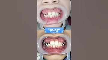 NIỀNG RĂNG CẤP TỐC ĐIỀU TRỊ KHỚP CẮN NGƯỢC Ở TRẺ EM