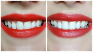 UPDATE | Crest 3D White Whitestrips Luxe Supreme FlexFit(PLEASE READ: It is time for a mid treatment update, so here it is! Only one more week to go until I achieve my 