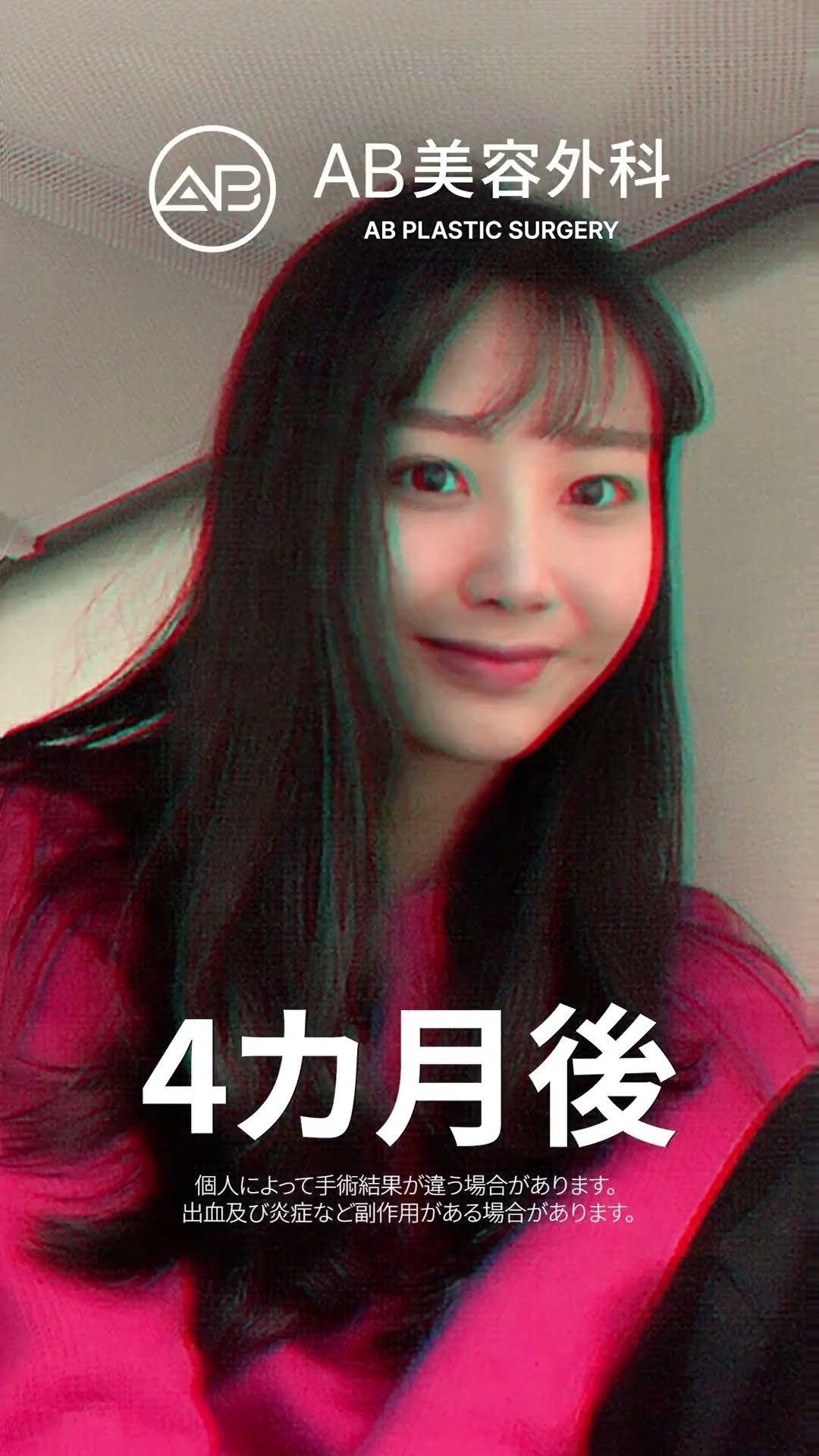 鼻整形で大変身！信じられないビフォーアフター✨結果をチェック！ #韓国整形 #整形ビフォーアフター #おすすめ