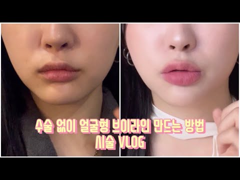 티타늄리프팅+입술필러+<strong>인모드</strong>