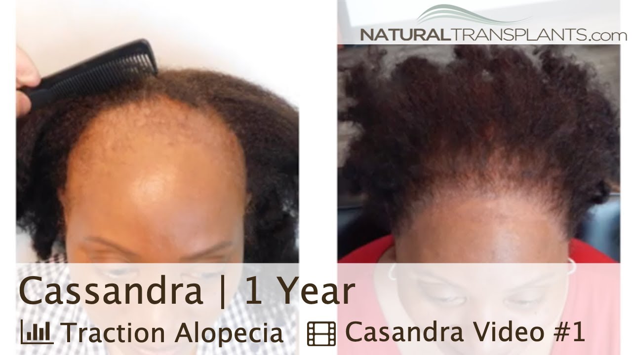 fue hair transplant month by month 1 Year Traction Alopecia Hair Transplant Results with Dr Huebner (Cassandra)