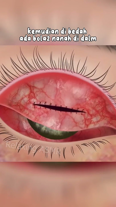 akibat memakai softlens lensa mata | bernanah #shorts #alurcerita  #asmr #fyp