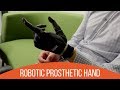 Review of The Bebionic Hand by Triple Amputee