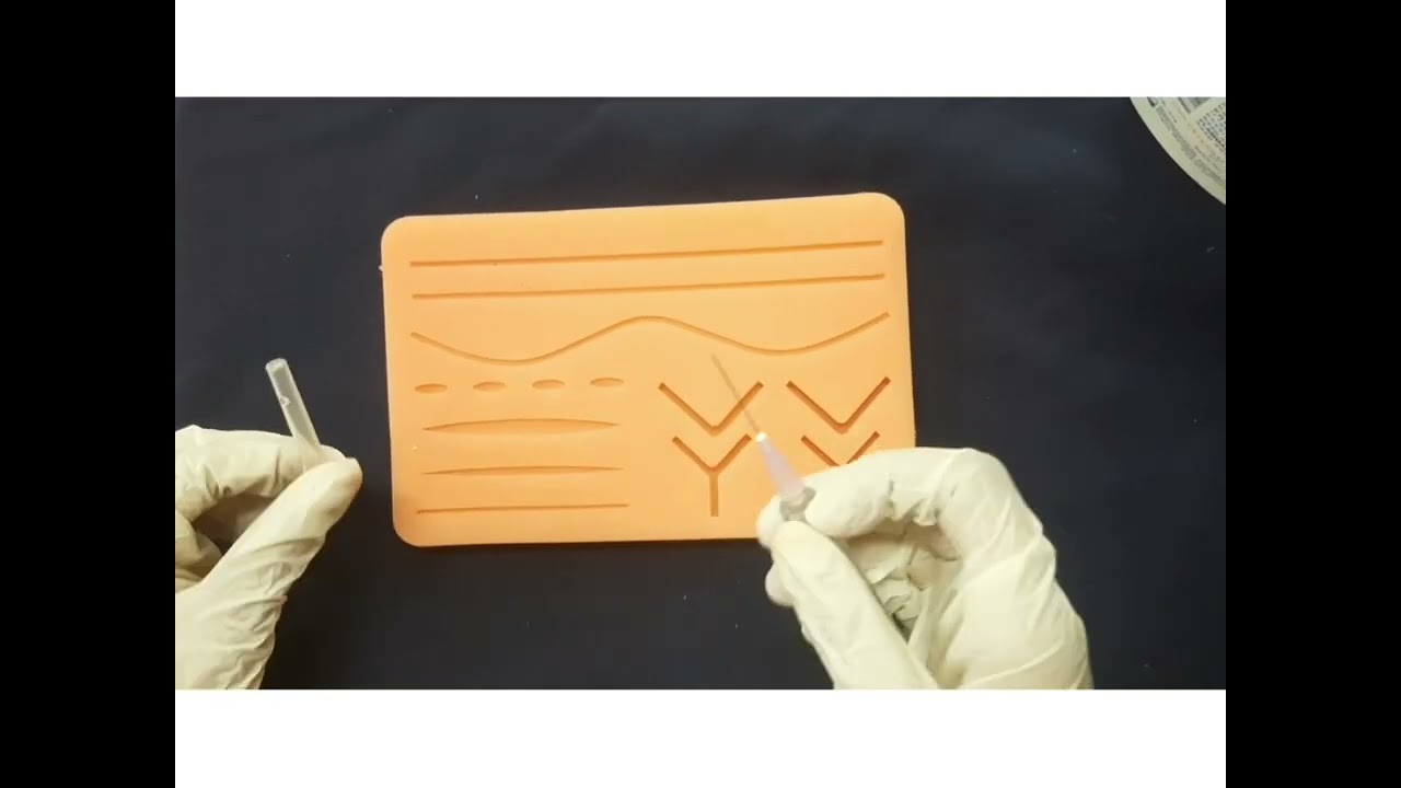 LOCAL INFILTRATION TECHNIQUE field block technique