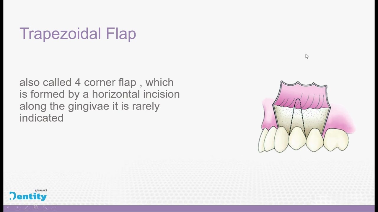 flap design and surgical extraction