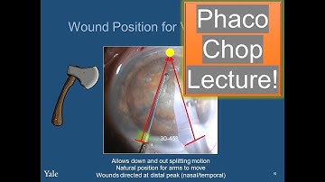 Phaco Chop Lecture- Chris Teng, MD