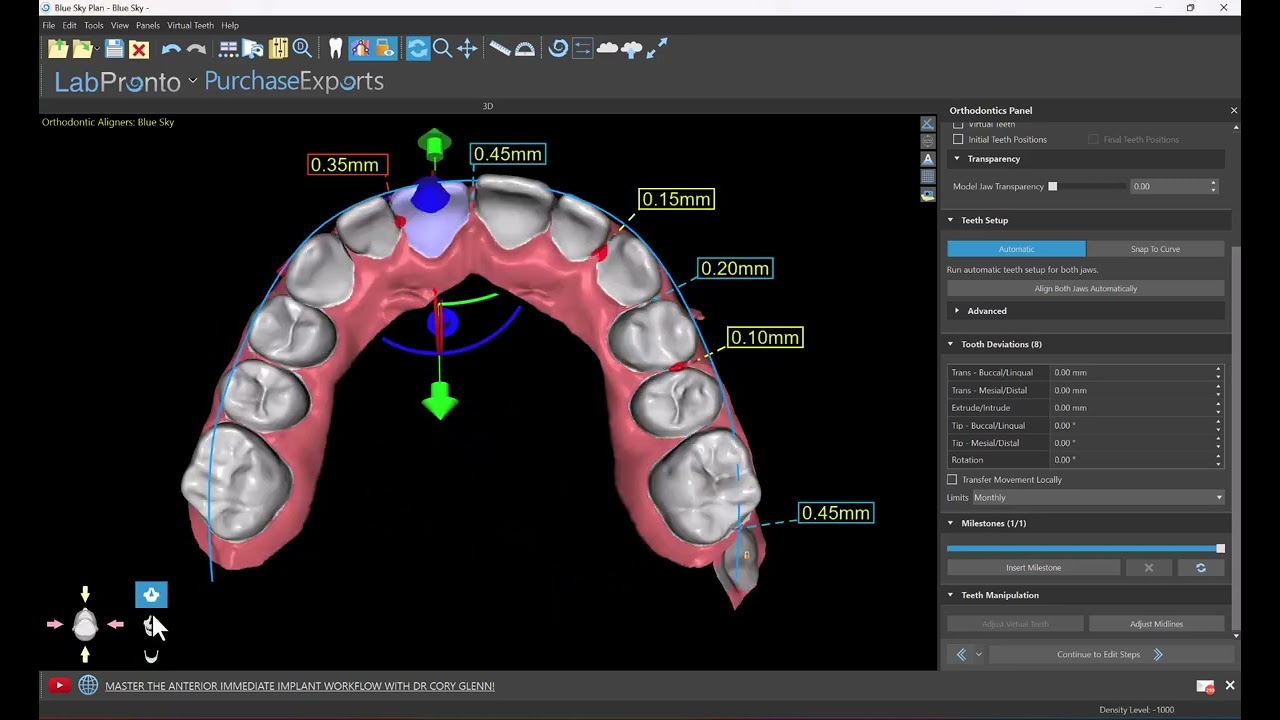 Aligner Wizard Automation in Blue Sky Plan Software