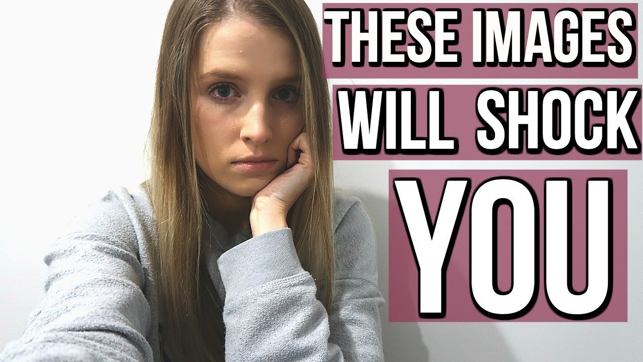 How Eating Disorders Can Be Life Threatening (GRAPHIC IMAGES) YouTube
