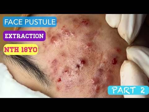 Mụn mủ trán|Dermatologist,pimples, whitehead blackhead,anti acne,pustule on the forehead NTH PART 2