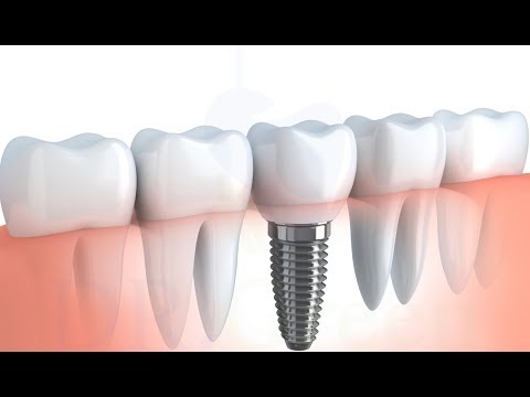 implant tedavisinin detaylı aşamaları (2 diş için)