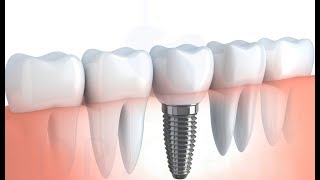 Implant Tedavisinin Detaylı Aşamaları 2 Diş Için