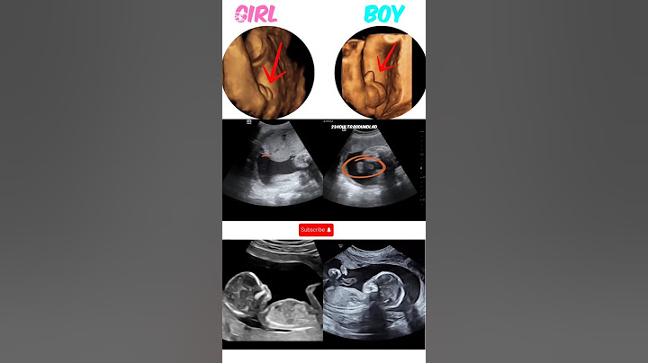 Baby Girl or baby boy,how they appear on ultrasound 2,3D #shortsfeed #shorts #baby