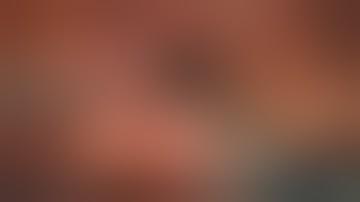 Robotic Right Lower Lobe superior segmentectomy (2x)(Xi system) Unedited