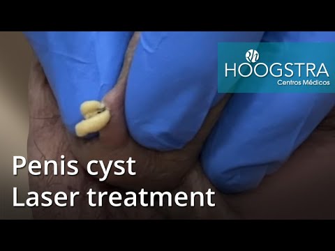 Cyst on dick