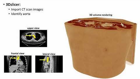Anisotropic quad mesh generation of a segmented thoracic aorta