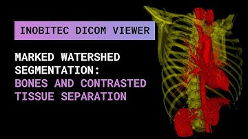 Marked watershed segmentation: bones and contrasted tissue separation