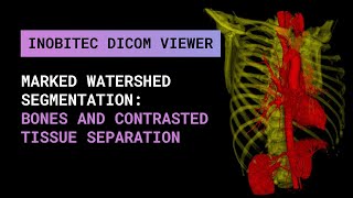 Marked watershed segmentation: bones and contrasted tissue separation