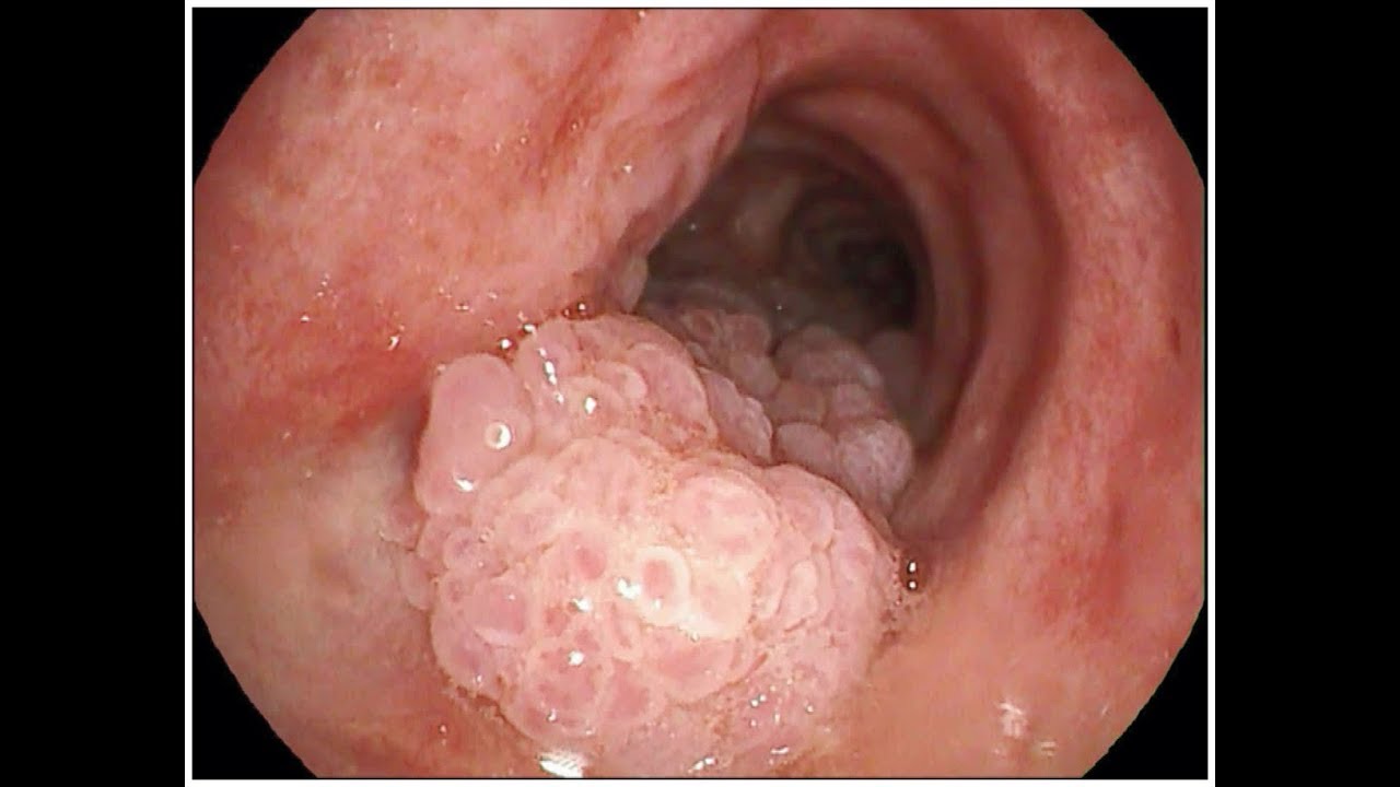 Condyloma a száj kezelésében. A condyloma acuminatum tünetei, kezelése és megelőzése