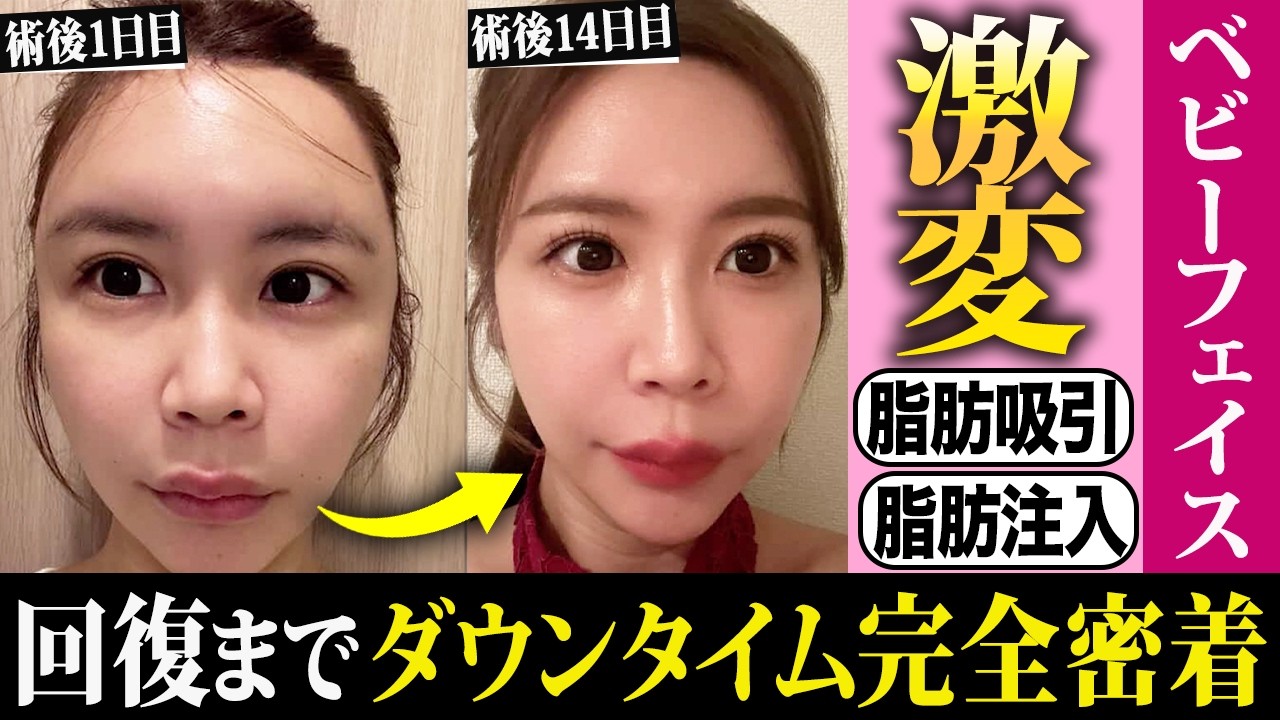 【劇的変化】脂肪吸引×脂肪注入で「バブみ顔」へ。14日間のダウンタイム全記録