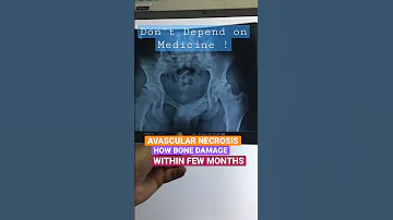 Avascular Necrosis-Dont depends on Medicine!! How bone collapse within few months #avntreatment