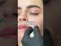 Full face com Belotero