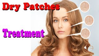 Dry Patches on Face | How to Deal with Dry Patches on the Face | Dry Patches on skin