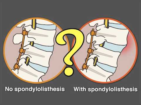 The Swedish Spinal Stenosis Study