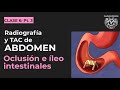 06.3 - Oclusión e íleo intestinales