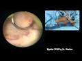 Bipolar turp 8 how to clear apex and do peripheral resection