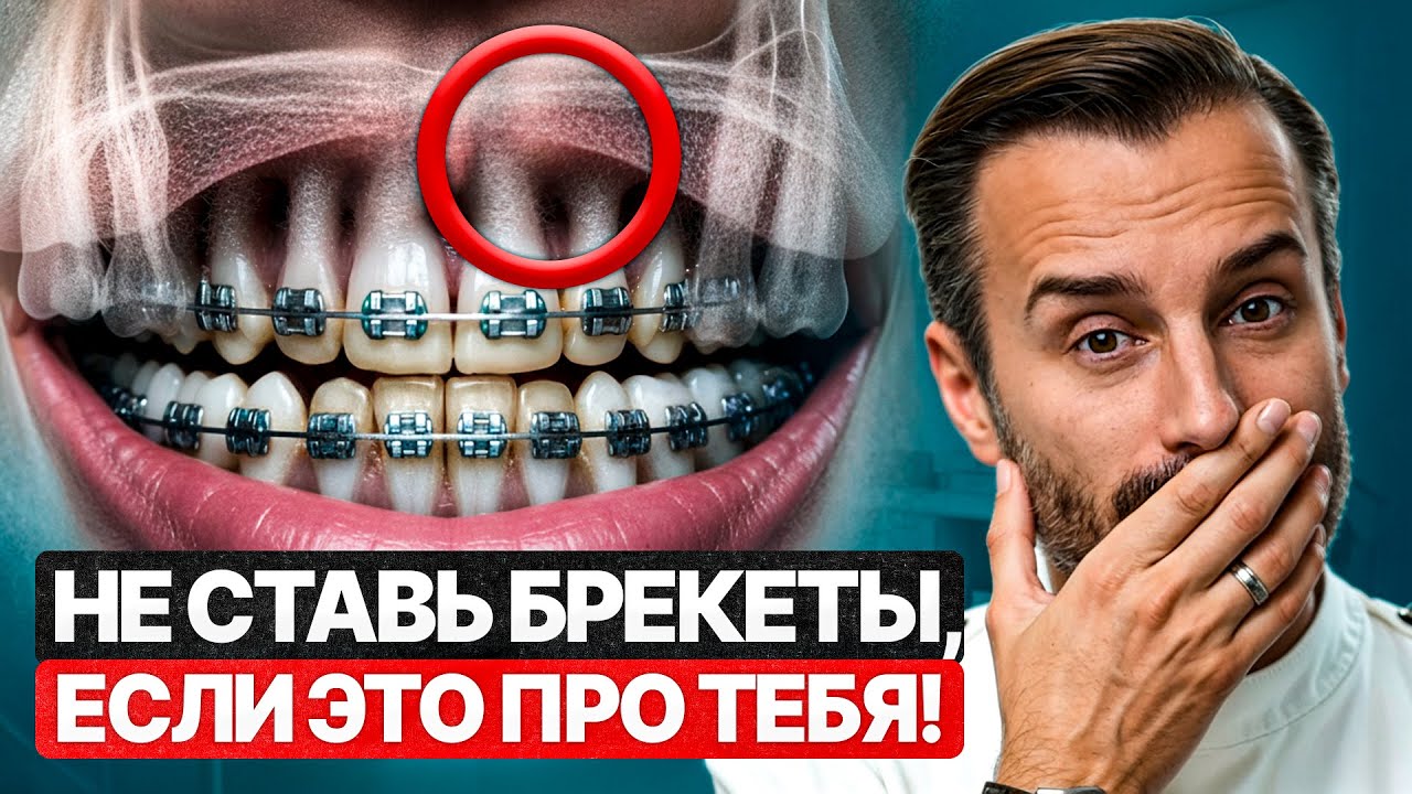 Когда НЕЛЬЗЯ ставить брекеты — всего 5 случаев